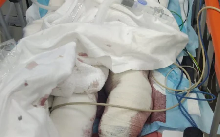 بعد محاولة لإنقاذه في مستشفى الملك فهد.. وفاة الطفل"عمر" متأثراً بجراحه إثر انفجار لغم
