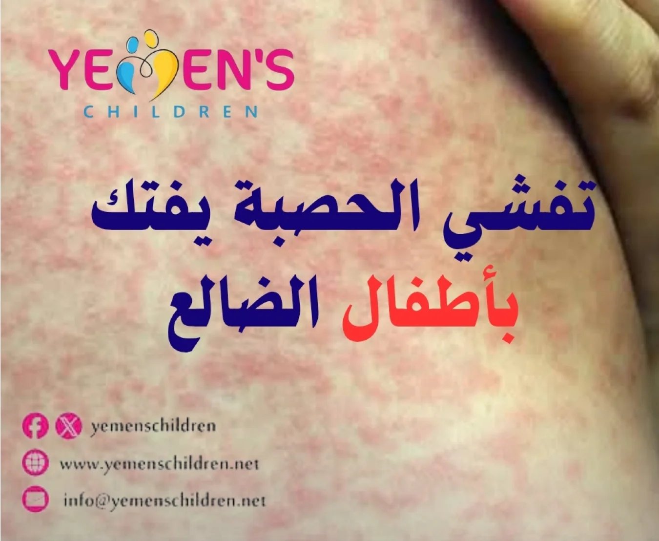 تفشي الحصبة يفتك بأطفال الضالع