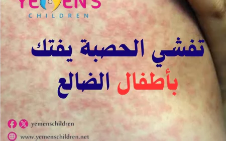 تفشي الحصبة يفتك بأطفال الضالع