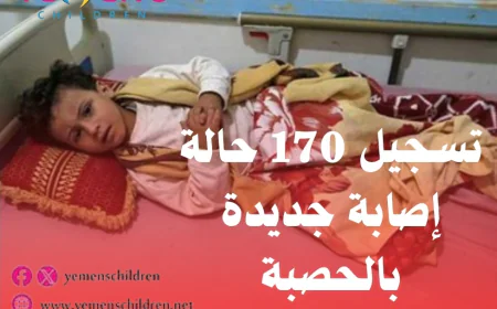 تسجيل 170 حالة إصابة جديدة بالحصبة