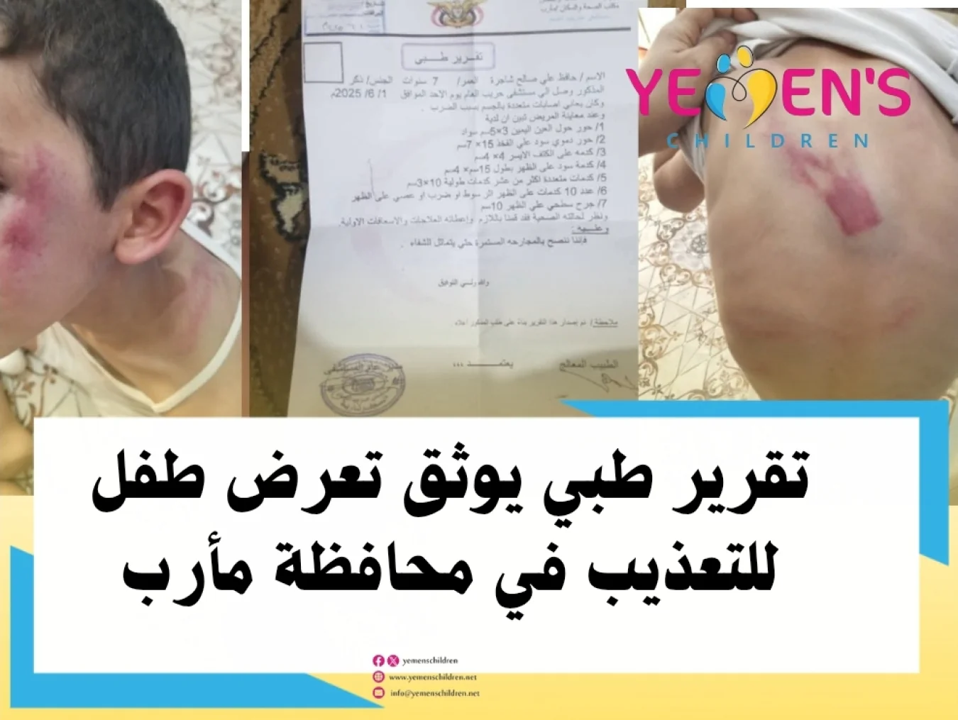 تقرير طبي يوثق تعرض طفل للتعذيب في محافظة مأرب
