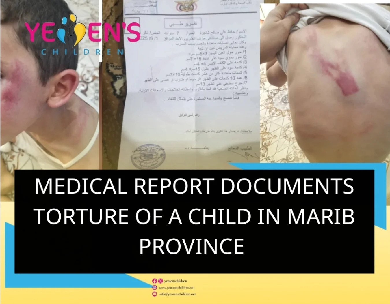 Medical Report Documents Torture of a Child in Marib Province