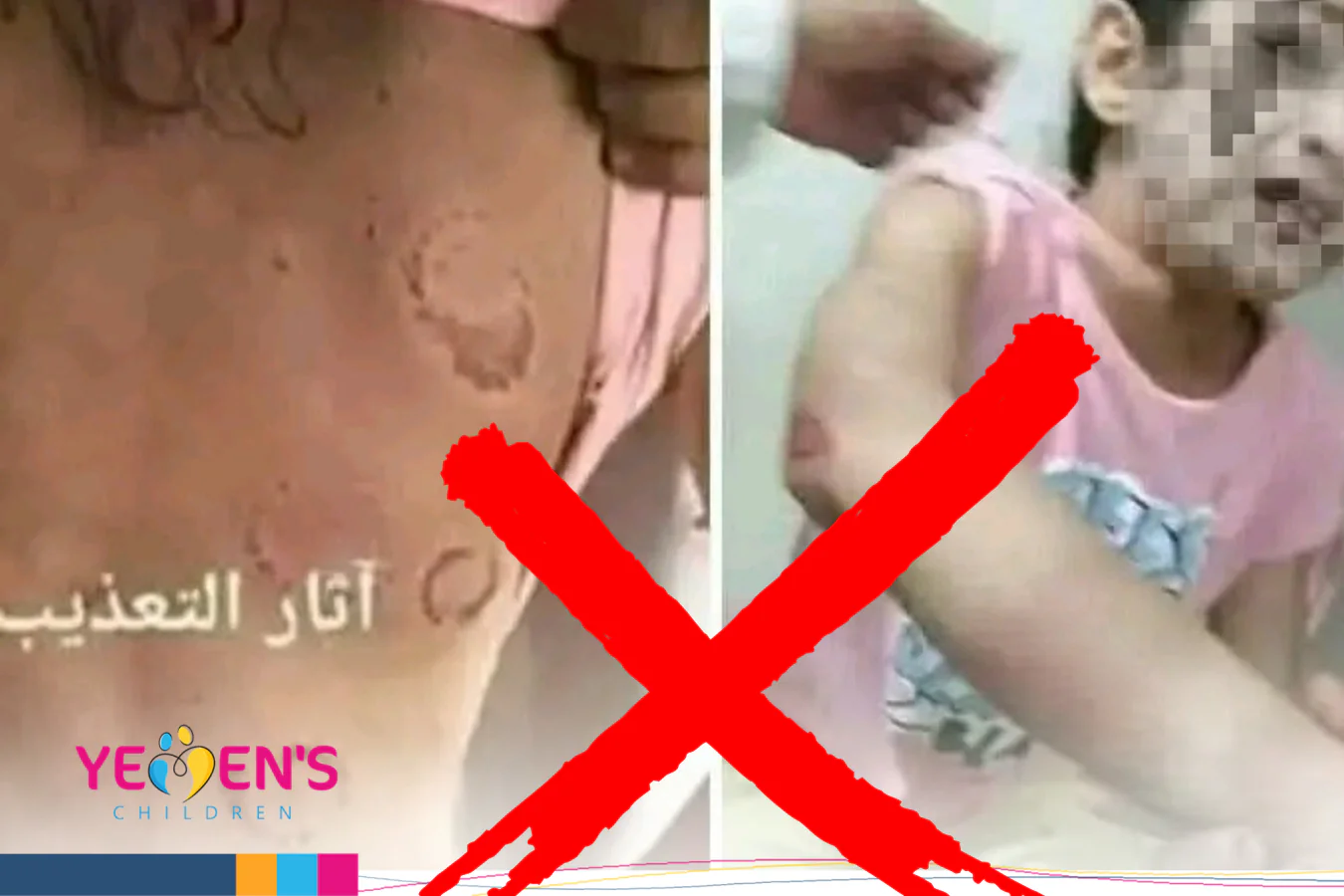 الصورة من  مصر وليست لتعذيب طفلة من قبل زوج ابيها في صنعاء