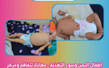 أطفال اليمن وسوء التغذية.. معاناة تتفاقم ومركز معالجة سوء التغذية بمستشفى كرى العام طوق النجاة