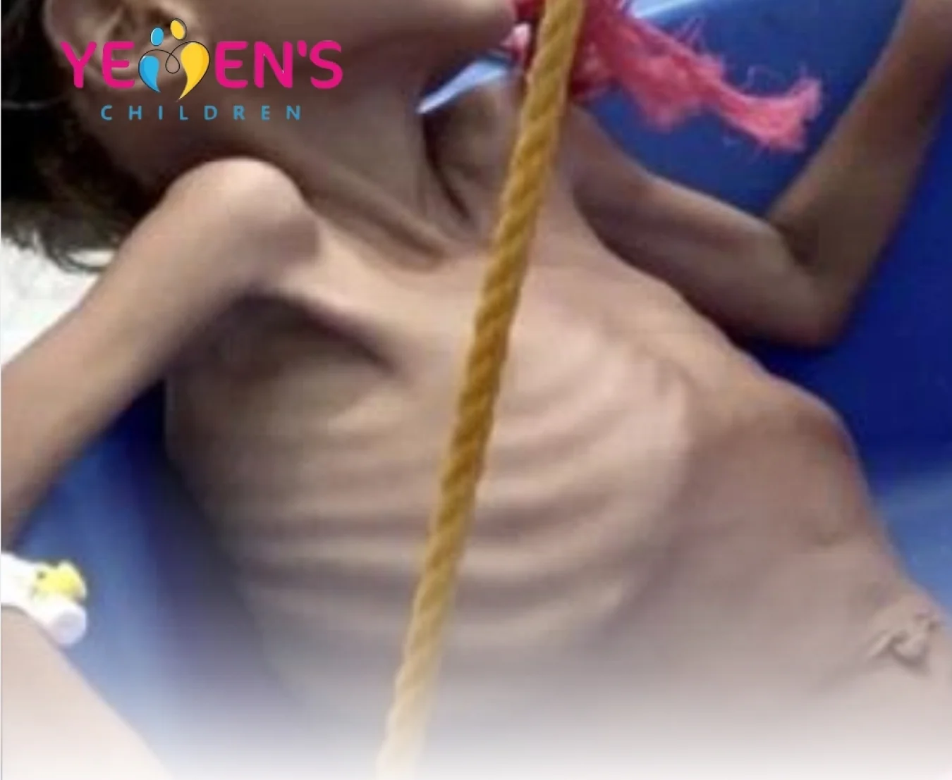 أزمة صحية متفاقمة تهدد 2.2 مليون طفل في اليمن