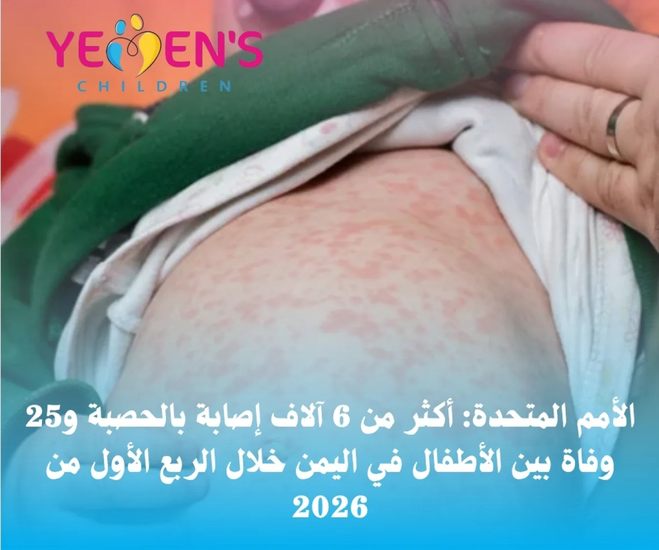 الأمم المتحدة: أكثر من 6 آلاف إصابة بالحصبة و25 وفاة بين الأطفال في اليمن خلال الربع الأول من 2026