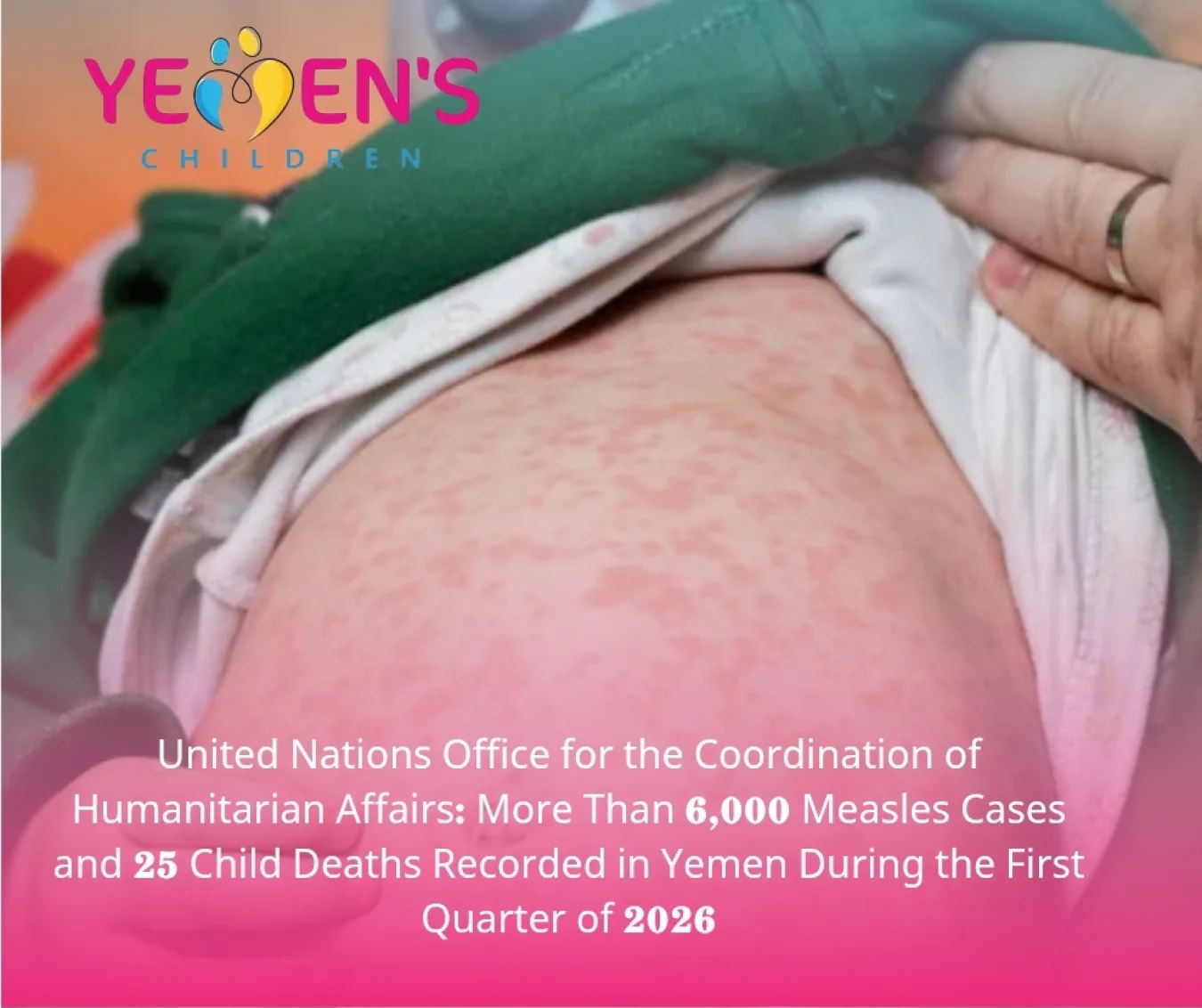 United Nations Office for the Coordination of Humanitarian Affairs: More Than 6,000 Measles Cases and 25 Child Deaths Recorded in Yemen During the First Quarter of 2026