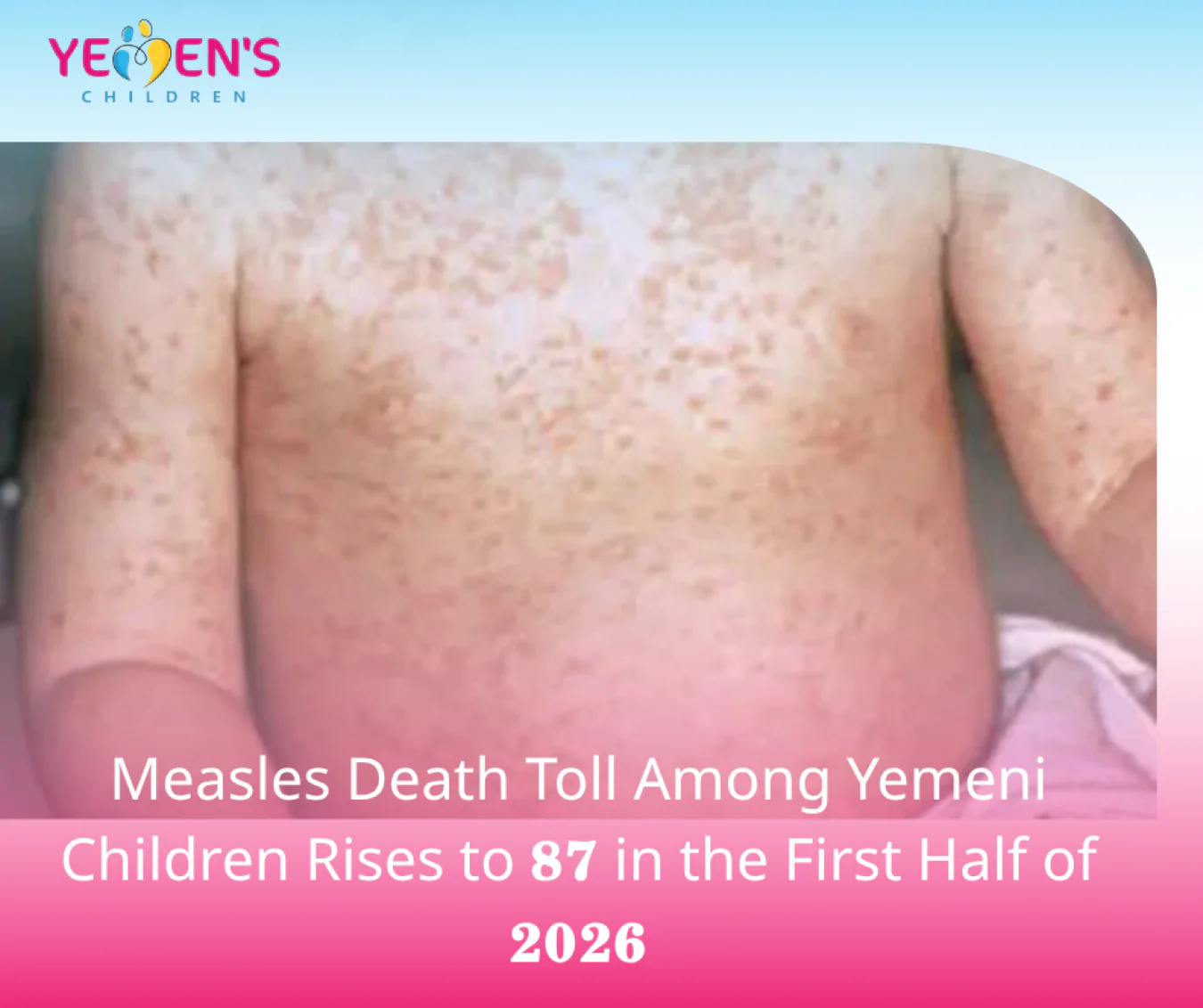 Measles Death Toll Among Yemeni Children Rises to 87 in the First Half of 2026