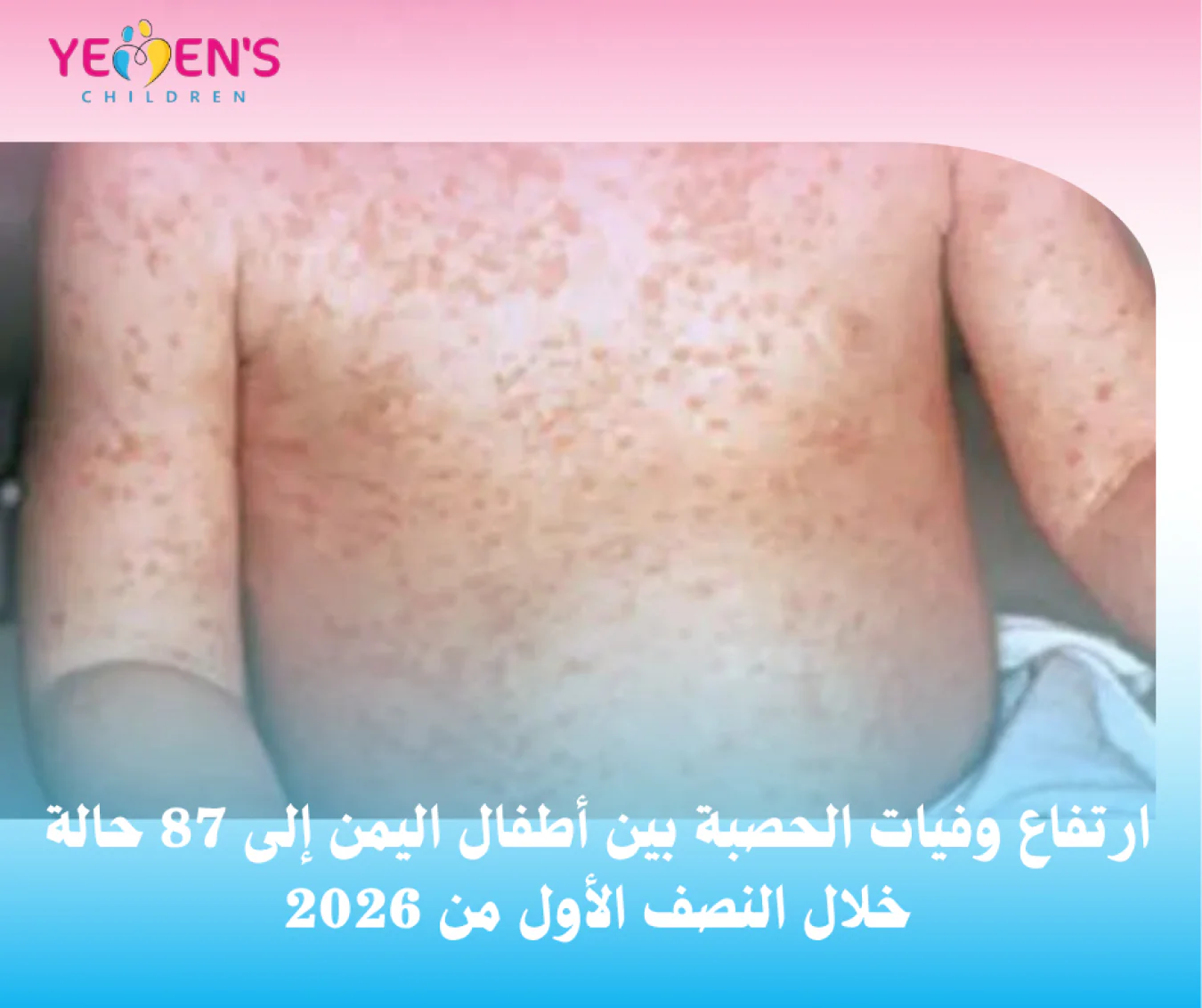 ارتفاع وفيات الحصبة بين أطفال اليمن إلى 87 حالة خلال النصف الأول من 2026