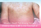 Measles Death Toll Among Yemeni Children Rises to 87 in the First Half of 2026