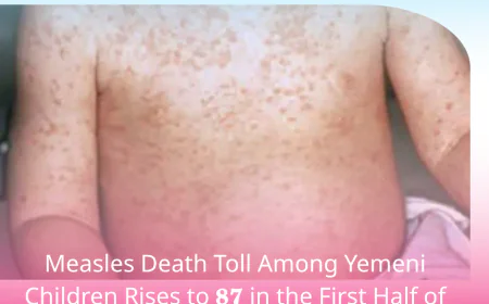 Measles Death Toll Among Yemeni Children Rises to 87 in the First Half of 2026